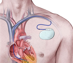 Pacemaker Defibrillator